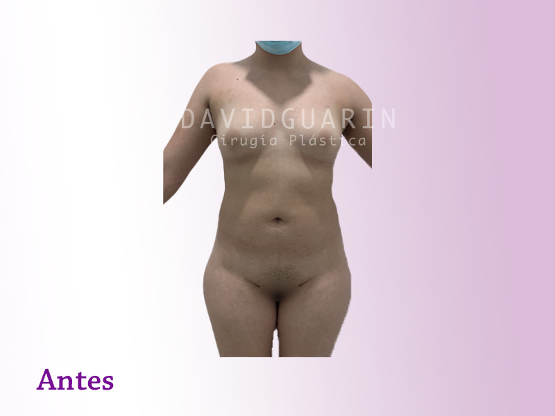 lipoescultura