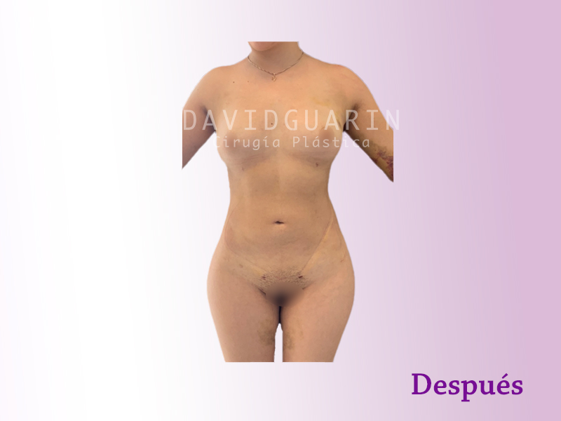 lipoescultura