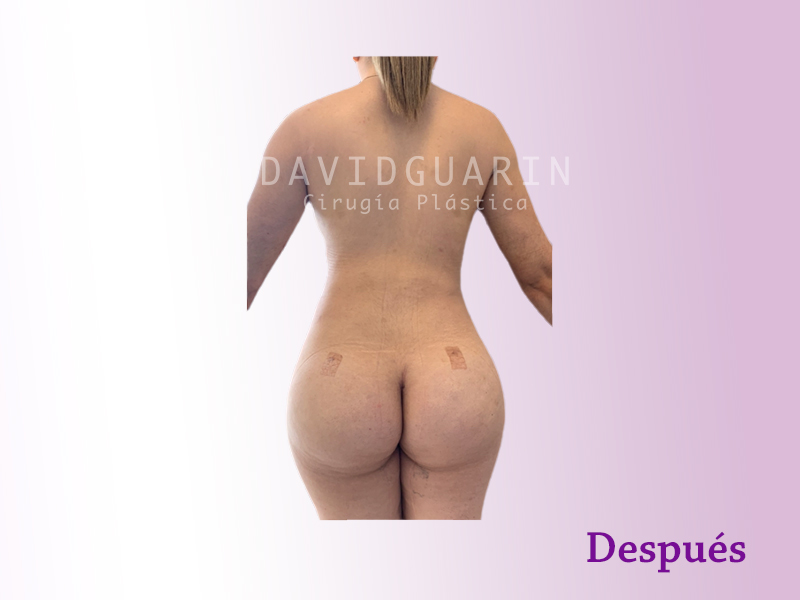lipoescultura