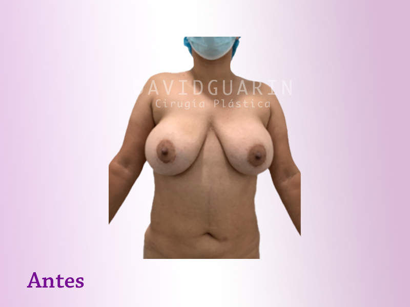 mastopexia